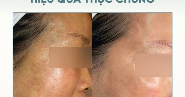 +4 serum tranexamic acid giúp mờ nám chân đinh lâu năm sau khoảng 8 tuần kiên trì