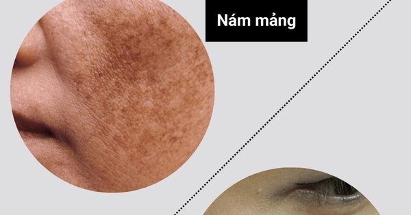 +3 kem mờ nám chân sâu sau khoảng 4 tuần khiến chị em không tin vào mắt
