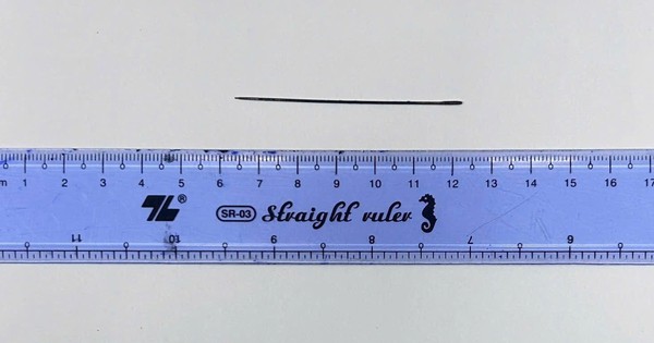 Kim may đồ nằm trong gan người đàn ông 41 tuổi