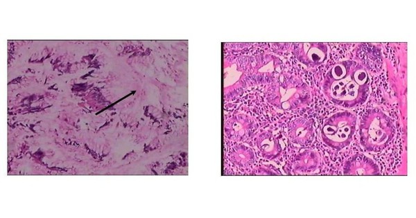 Đi chân đất, dùng corticoid tùy tiện: Nguy cơ giun lươn gây biến chứng nguy hiểm