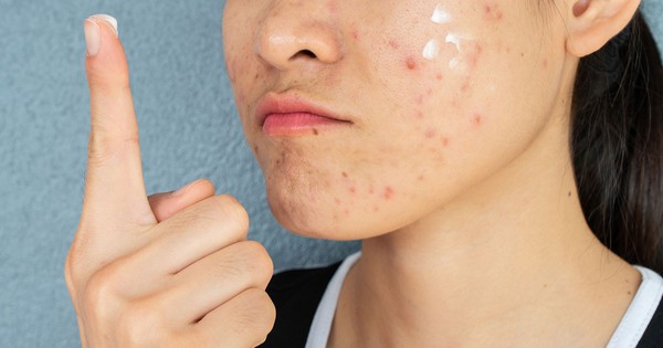 Da vùng má dễ bị thâm mụn? Cách chăm sóc da giúp da đều màu hơn