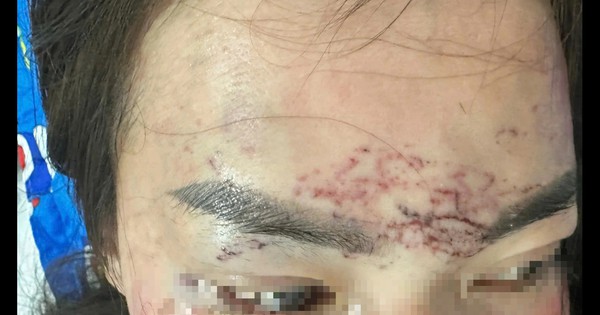 Chủ cơ sở thẩm mỹ đánh ghen, bắt giữ người trái pháp luật sắp ra tòa xét xử