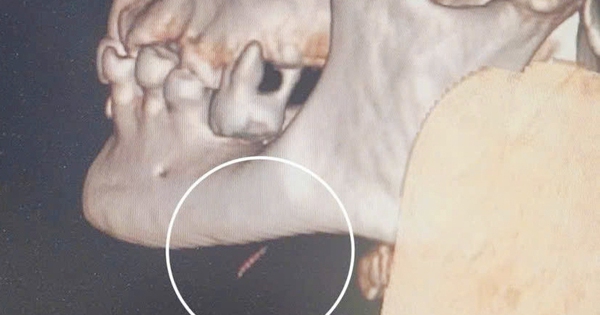 Nuốt phải xương cá, cụ bà 77 tuổi bị áp xe dưới cằm