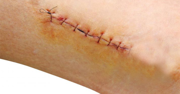 Vai trò kiểm soát viêm sớm trong giảm sẹo hậu phẫu