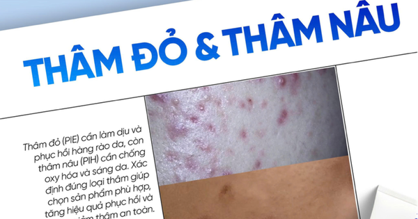 Top cách chăm sóc da thâm đỏ sau mụn bạn nên thử ngay trong routine hằng ngày