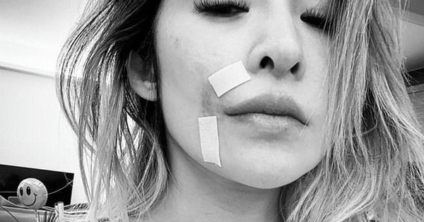 Diva Đài Loan Tiêu Á Hiên biến dạng gương mặt sau khi bị chó tấn công