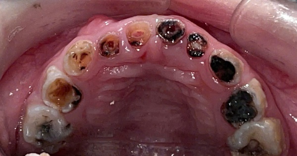 Gây mê chữa răng có phải là 'cho bệnh nhân ngủ để chữa cho nhanh'?