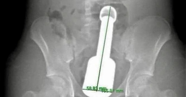 Metal Rod Lodged in Rectum: Adolescence and the Mindset of 'Let’s See What Happens'