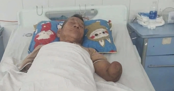 Cụ ông Đà Nẵng bị rắn hổ mang cắn vẫn kẹp rắn về nhà, sức khỏe đã ổn định