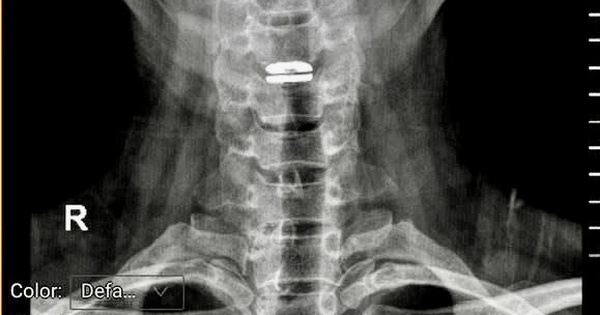 Sai lầm khi trị đau cổ vai gáy có thể gây liệt