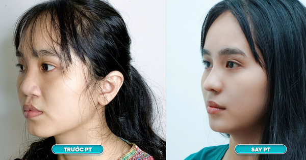 Bệnh viện JK Nhật Hàn miễn phí phẫu thuật 20 case mũi