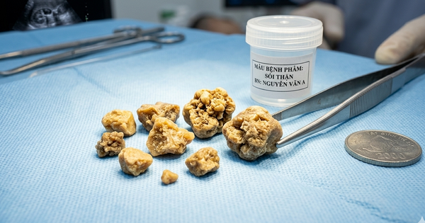 Sỏi thận có thể tự đào thải được không?