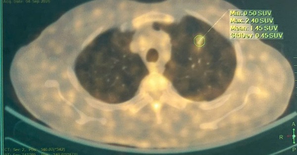 Bệnh viện Bạch Mai phát triển AI hỗ trợ chẩn đoán chính xác ung thư phổi