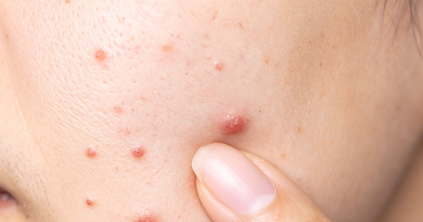 Vừa nặn mụn xong nên bôi gì để giảm đỏ nhanh hạn chế để lại sẹo rỗ