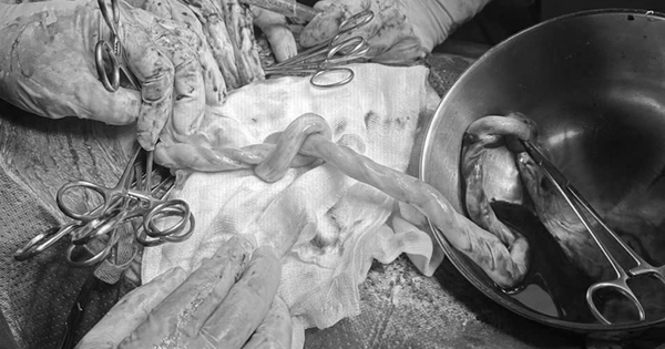 Thắt nút dây rốn, thai nhi nguy cơ tử vong rất cao