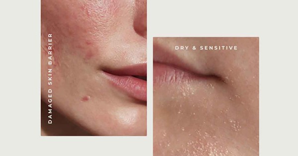 Da yếu là gì? Dấu hiệu và cách phục hồi hiệu quả trong 4 tuần