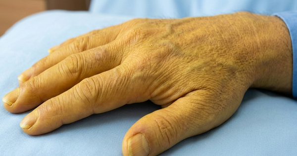 3 biểu hiện ở gan báo động nguy cơ đe dọa tính mạng