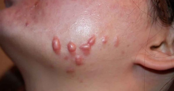 Chuyên gia Rejuvaskin bật mí cách mờ sẹo lồi do mụn hiệu quả theo đúng giai đoạn