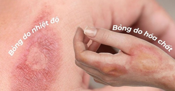 Quá trình lành vết bỏng: Sai một bước, sẹo cả đời