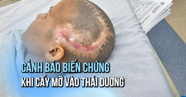 Khuyến cáo cấy mỡ vào thái dương gây biến chứng đột quỵ não