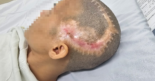 TP.HCM: Đột quỵ sau phẫu thuật thẩm mỹ hút mỡ bụng, cấy mỡ