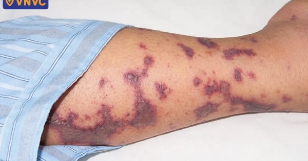 4 ca tử vong do bệnh não mô cầu, nguy cơ xuất hiện thêm các ca bệnh