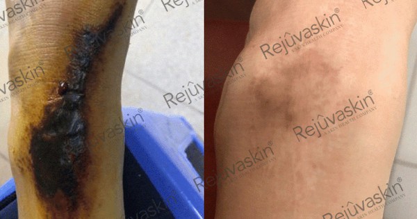 Sẹo phì đại ở khớp: nguyên nhân, nguy cơ và hướng điều trị sớm