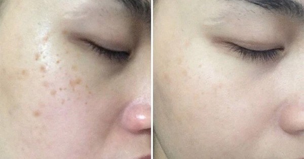 Top 5 serum giúp ‘tạm biệt’ nám, thậm chí nám hỗn hợp tưởng như chưa tồn tại