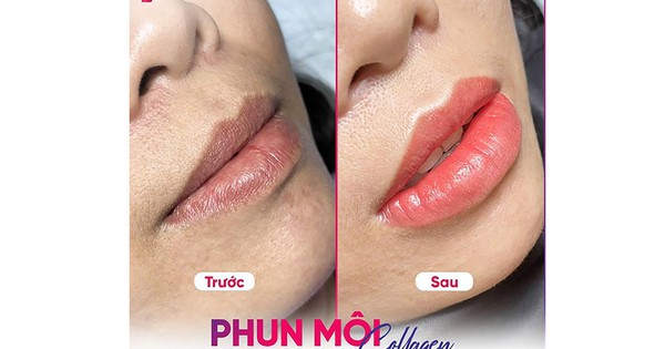 Thẩm mỹ viện Seoul Center - địa chỉ phun môi uy tín, đẹp, bền lâu