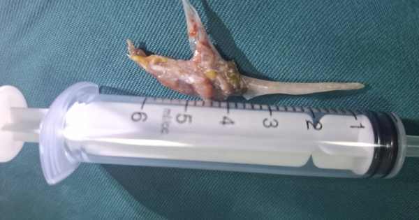 Nuốt đinh, hóc xương, rơi răng giả: Những ca cấp cứu khiến bác sĩ toát mồ hôi