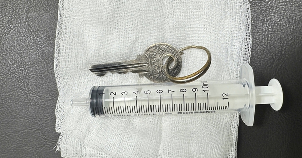 Nội soi, gắp chiếc chìa khóa cửa trong dạ dày bệnh nhi 14 tuổi