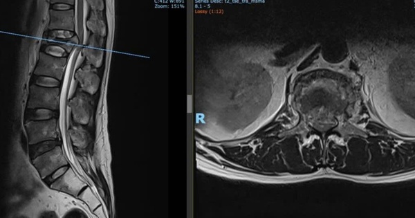 Cứu bệnh nhân bị hội chứng chùm đuôi ngựa do tai nạn lao động