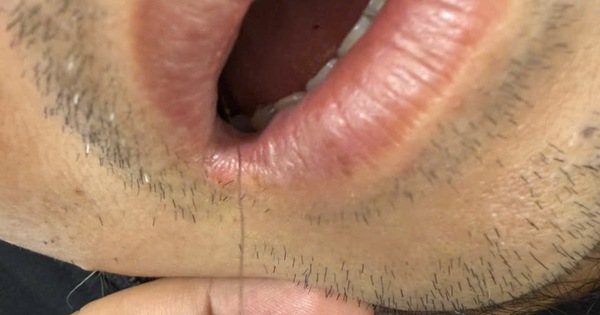 Hy hữu: Dây cước lộ ngoài miệng, bác sĩ nội soi gắp lưỡi câu khỏi thực quản