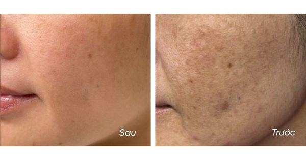 5 kem giúp mờ nám, da trắng sáng sau khoảng 4 tuần, kể cả nám hỗn hợp
