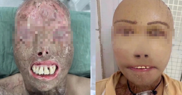 Ngã vào nồi nước sôi và hành trình 16 giờ 'trao trả' gương mặt