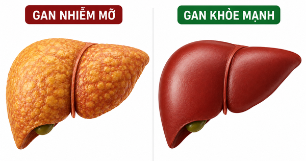 Loại vitamin quen thuộc có thể là 'cứu tinh' cho gan nhiễm mỡ