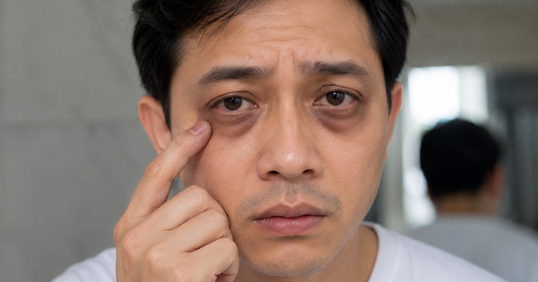 Bác sĩ: Nhìn vào mắt có thể phát hiện dấu hiệu gan nhiễm mỡ