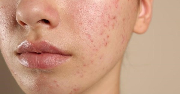 Kháng kháng sinh trong điều trị mụn và giải pháp thay thế từ tia Plasma lạnh