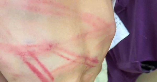 Father investigated for beating 9-year-old son with pipe in Quang Tri