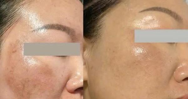 +5 serum mờ nám mảng loang lổ khắp mặt cũng cải thiện, da bật tone trắng hồng