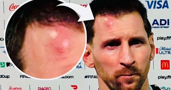 Messi sưng vêu trán sau trận thắng Cabo Verde: Vì sao nên nỗi?
