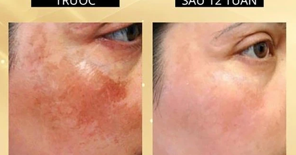 +7 kem mờ nám giúp da sau sinh vẫn trắng hồng rạng rỡ, mẹ tự tin hơn