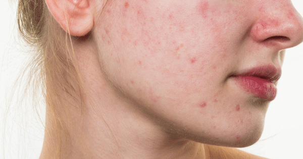 Trioderma Intensive Acne Spot Gel và bài toán chấm mụn không làm khô da