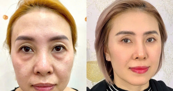 Xóa tan quầng thâm mắt bằng công nghệ Hydro Ultra Lift