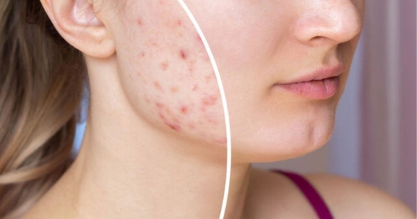 Mụn mãi không hết, chuyên gia da liễu chỉ ra nguyên nhân không ai ngờ tới