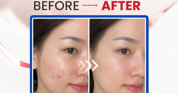 Top 5 kem chấm mụn giúp mụn viêm sưng xẹp sau khoảng 1 đêm ngừa sẹo thâm