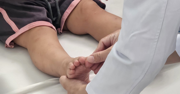 Gần 100.000 ca tay chân miệng: Cảnh giác virus EV71 gây biến chứng thần kinh
