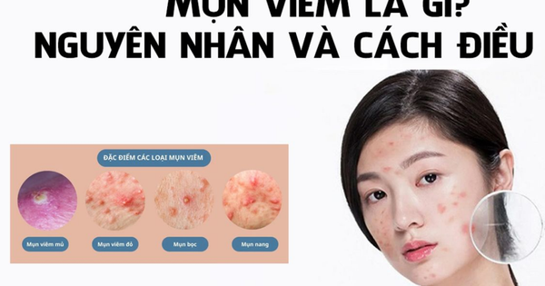 Bị mụn viêm sưng nên nặn không? Cần làm gì hết mụn mà không để lại sẹo?