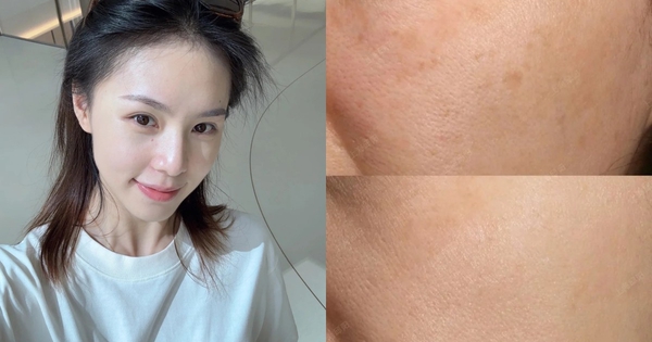 Top 6 serum mờ nám, tàn nhang sau khoảng 4 tuần khiến chị em đều không tin