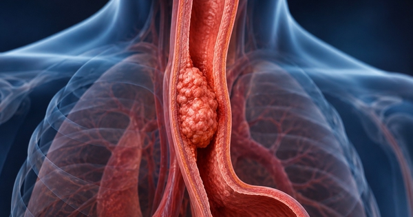 Nhật Bản đưa vào sử dụng liệu pháp virus điều trị ung thư thực quản